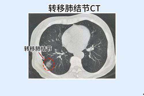 肺结节可以吃瓜吗,瓜类食物的适宜与禁忌